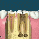 Root canal and crown prep procedure 