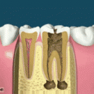 Root canal treatment and dental crown